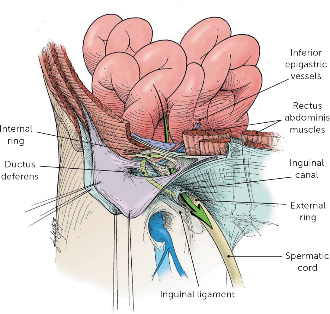 JCDR - Femoral hernia, Gangrenous bowel, Inguinal hernia, One skin