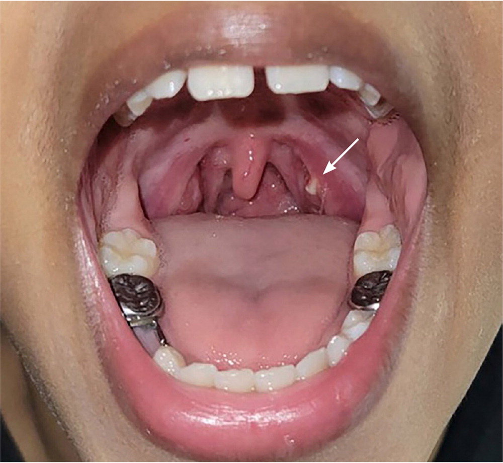 Tonsillitis And Tonsilloliths Diagnosis And Management AAFP