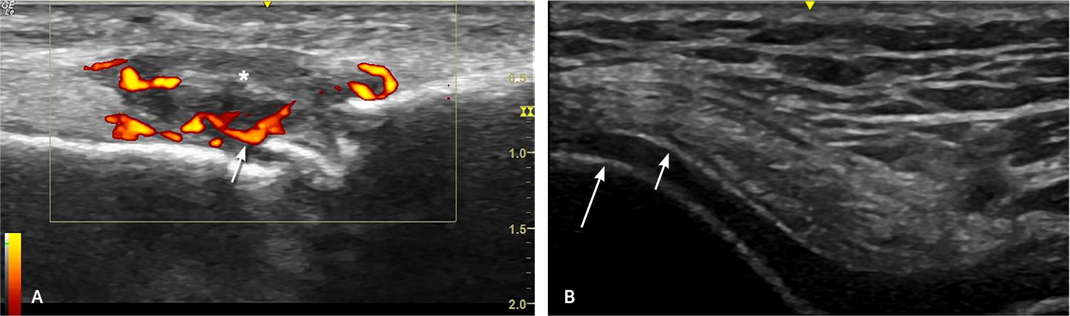 Polyarticular Joint Pain In Adults Evaluation And Differential Diagnosis AAFP