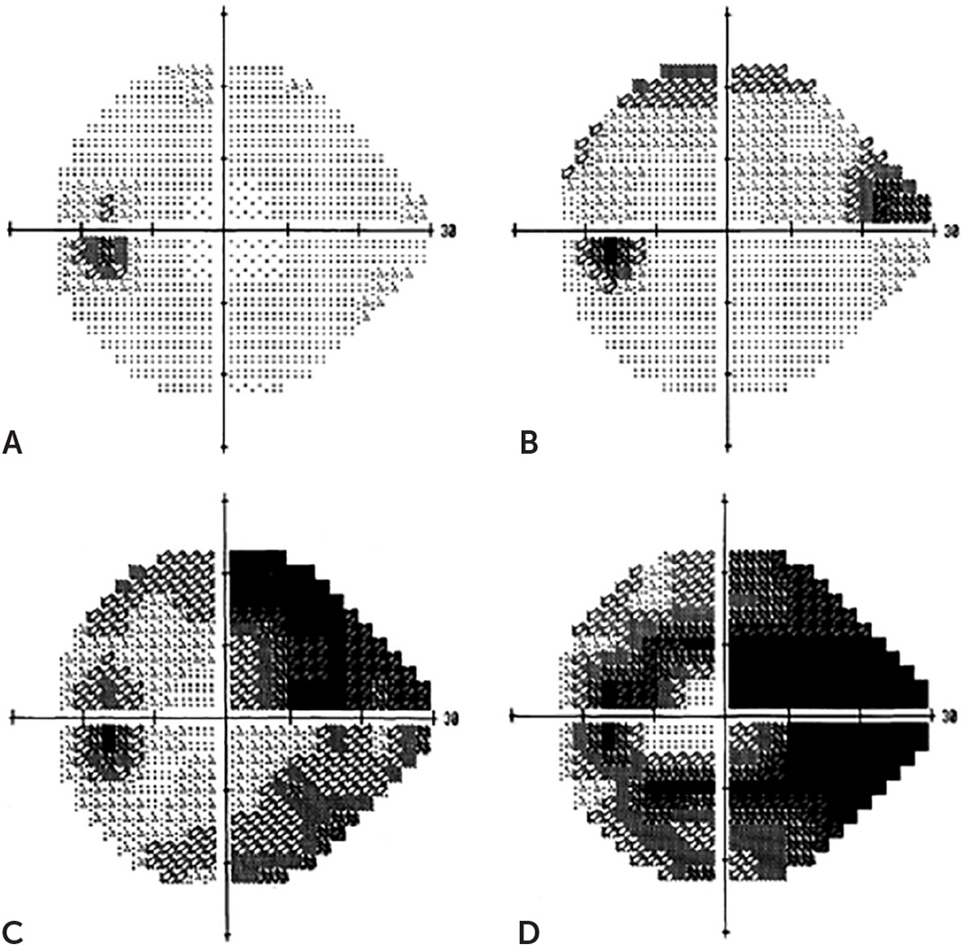 Glaucoma: Diagnosis and Management | AAFP