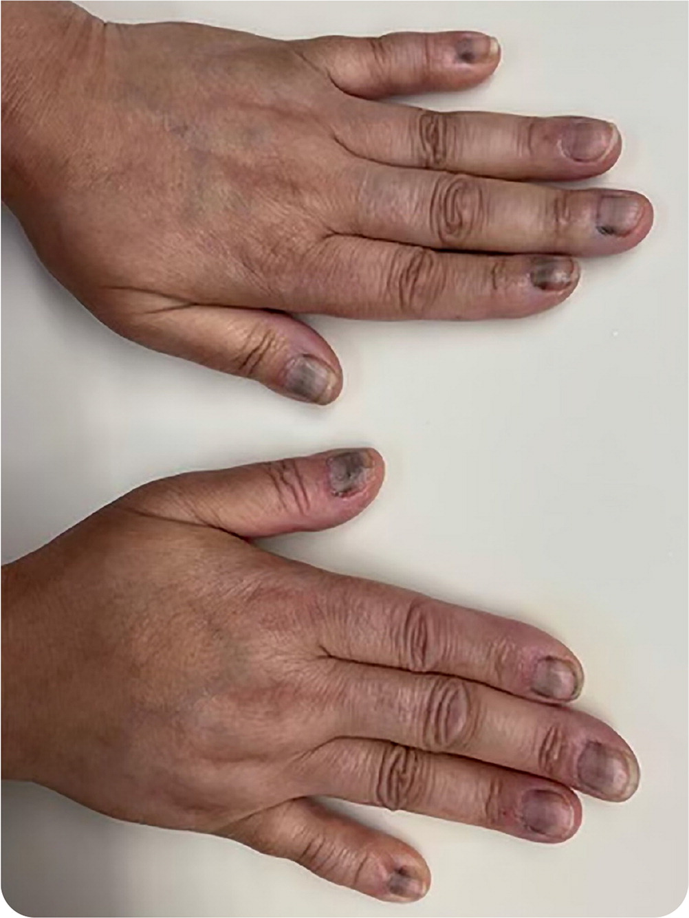 Black Fingernail Discoloration AAFP