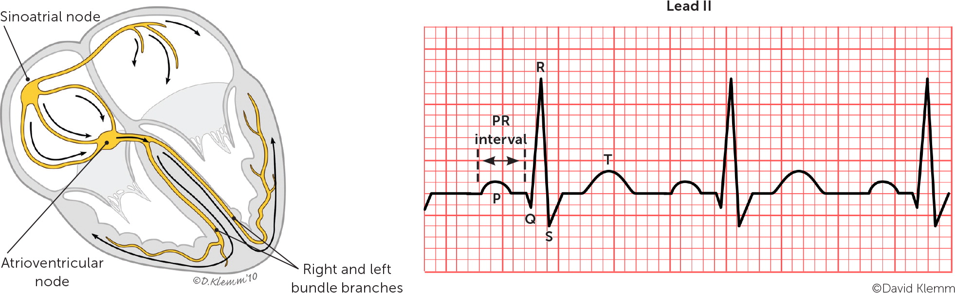 Common Types of Supraventricular Tachycardia: Diagnosis and Management ...