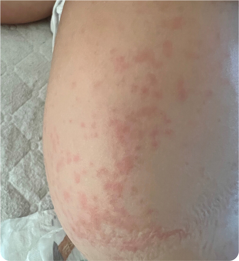 fever-and-skin-rash-aafp