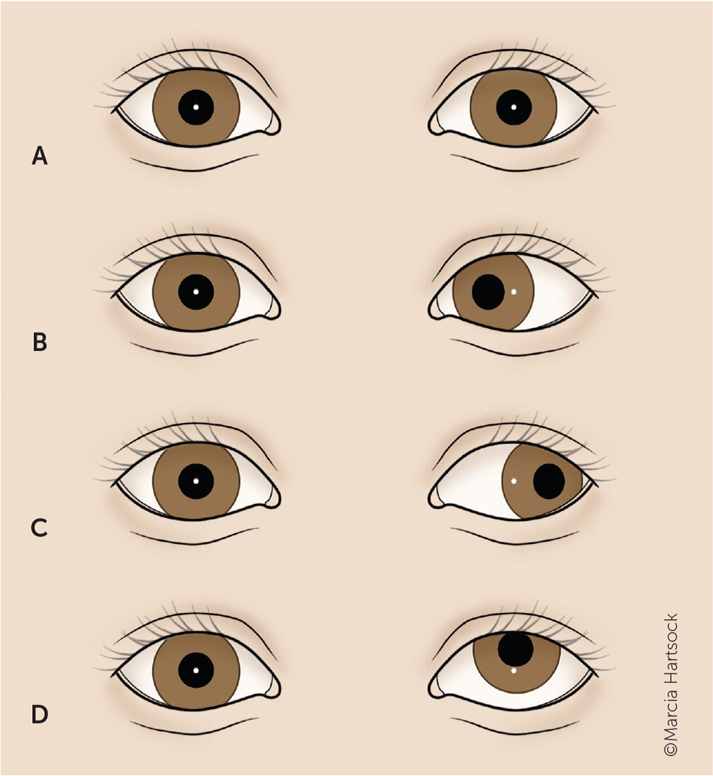 Childhood Eye Examination In Primary Care | AAFP