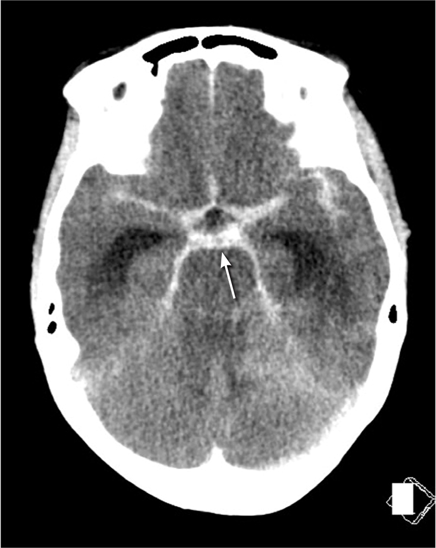 Ottawa SAH Rule – Peripheral Brain