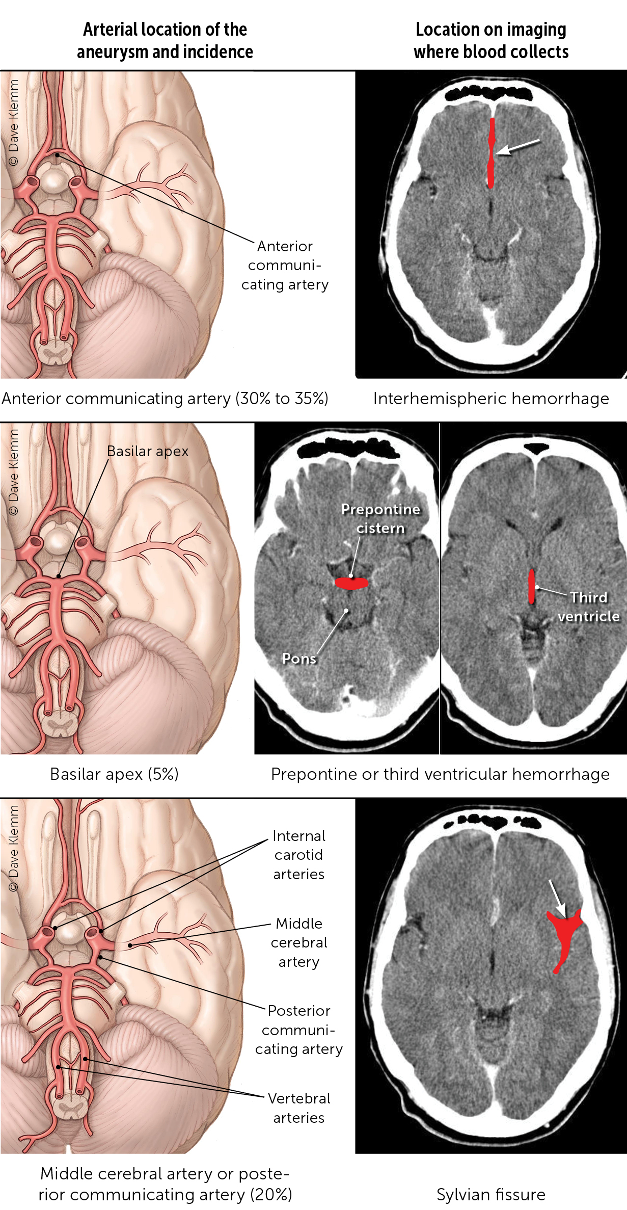 Imaging Evaluation of SAH and Aneurysm