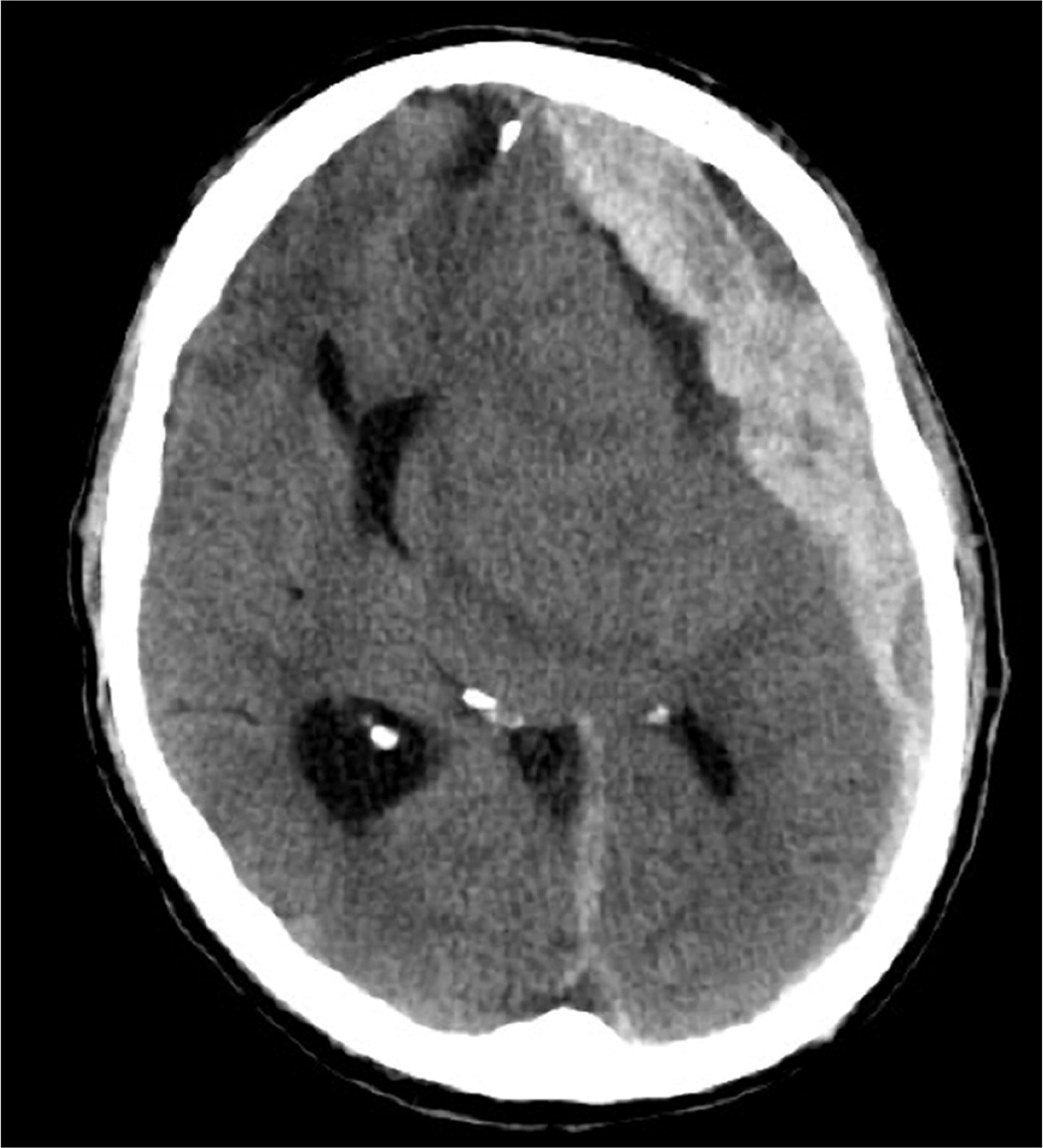 Nontraumatic Subarachnoid Hemorrhage and Ruptured Intracranial Aneurysm ...