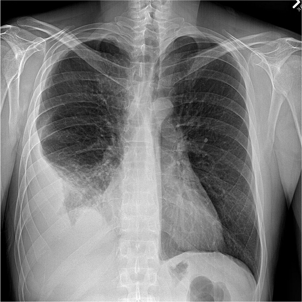 Pleural Effusion: Diagnostic Approach In Adults | AAFP