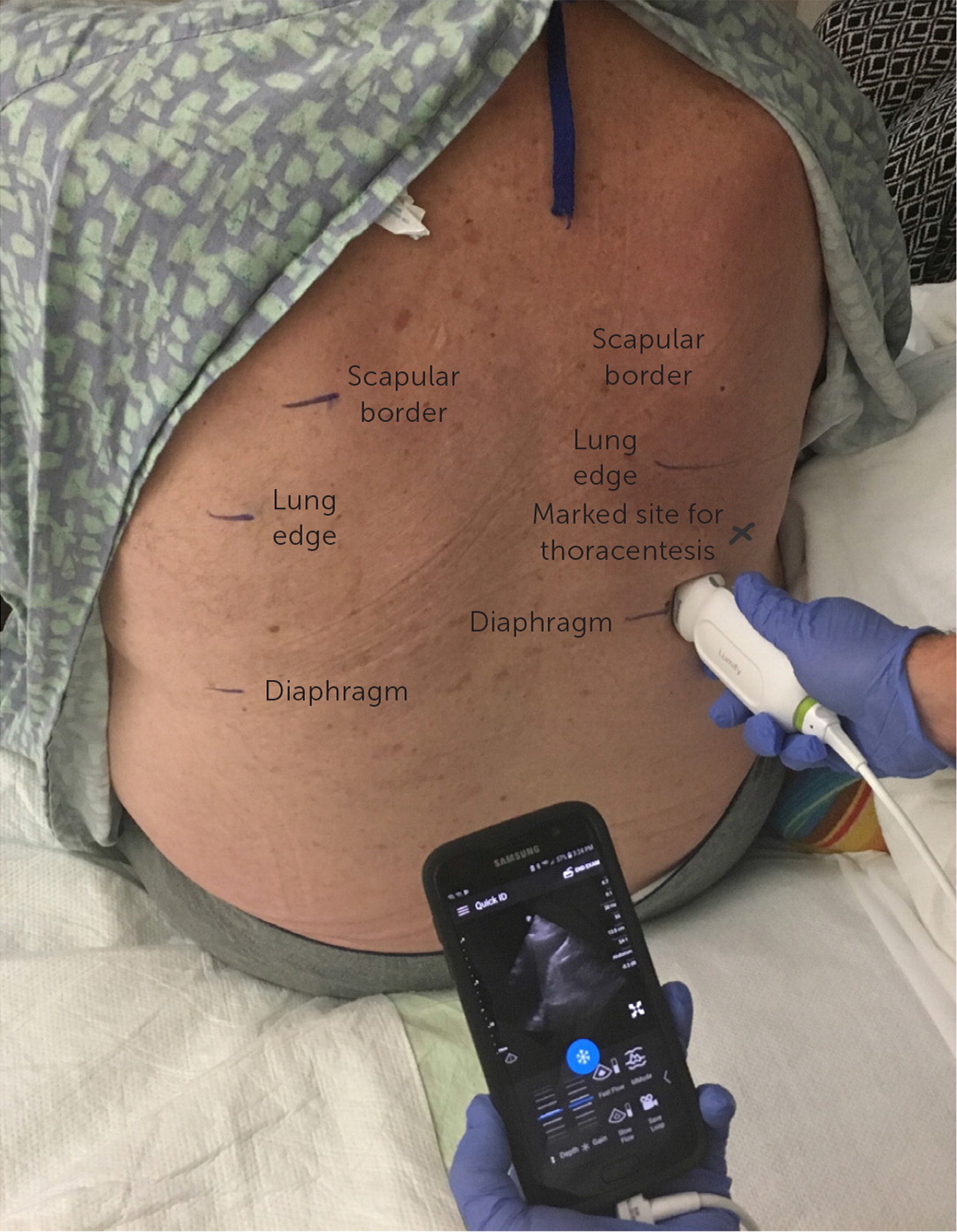 Pleural Effusion: Diagnostic Approach In Adults | AAFP