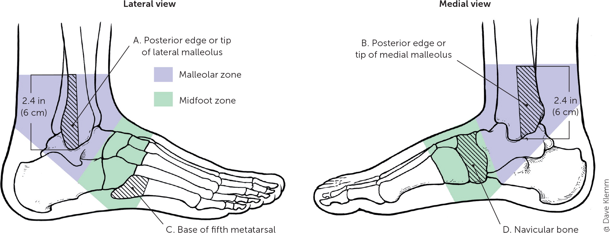 Common Foot Fractures | AAFP