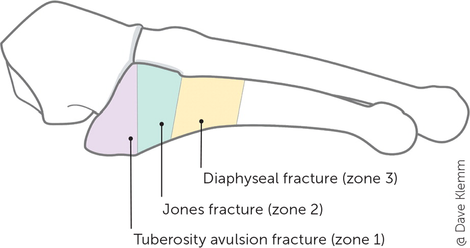 Common Foot Fractures | AAFP