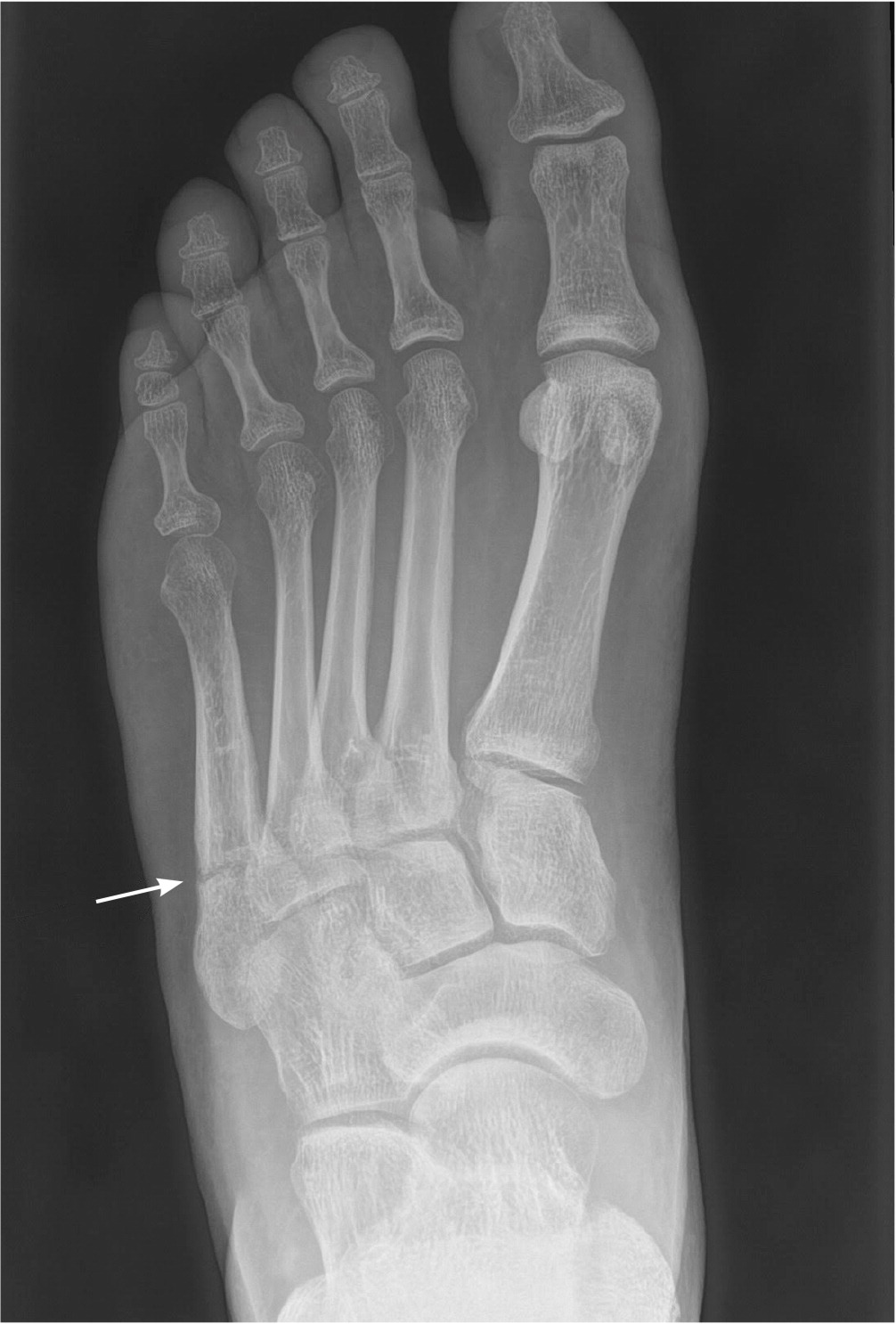 Common Foot Fractures | AAFP