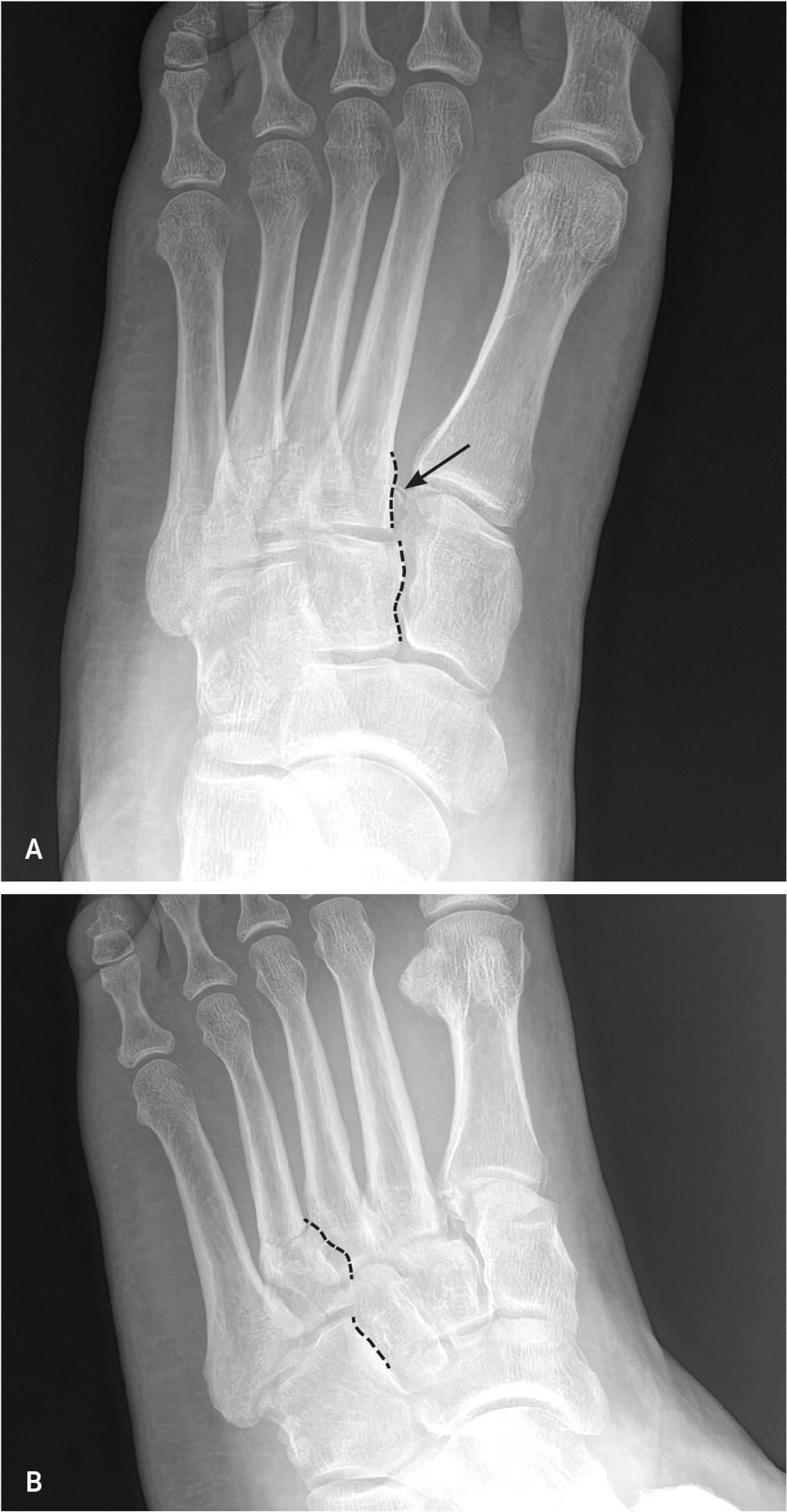 Common Foot Fractures | AAFP