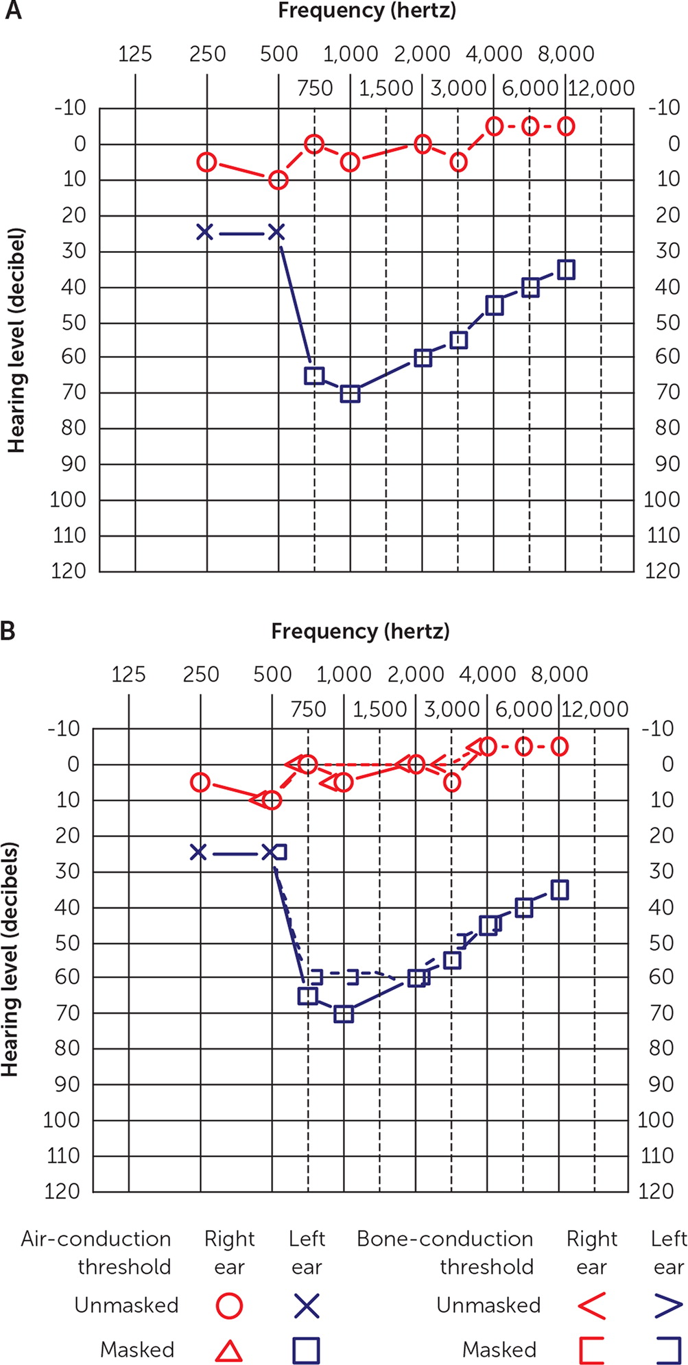 Audiometry Interpretation for Hearing Loss in Adults | AAFP