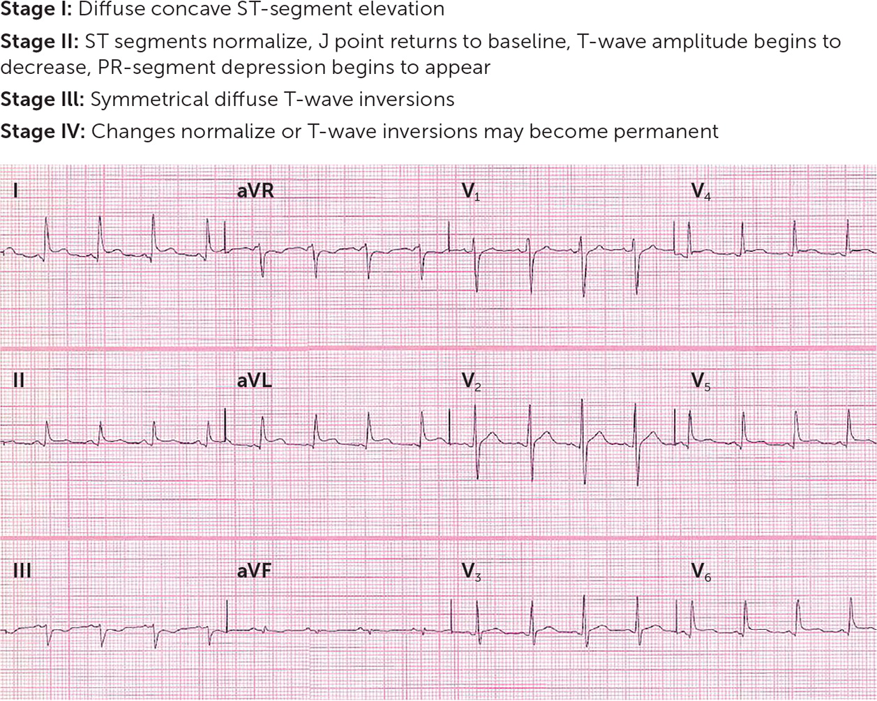 Acute Pericarditis: Rapid Evidence Review | AAFP