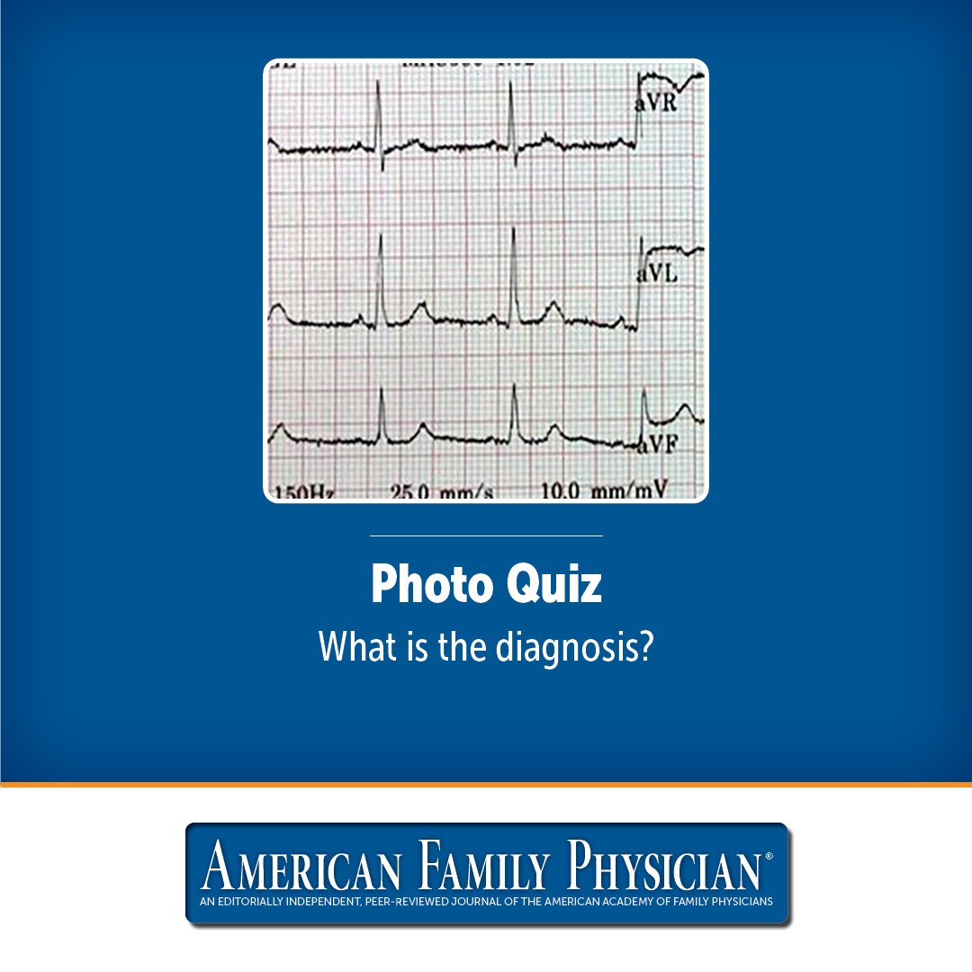 a-shortness-of-breath-from-releasing-too-many-thyroid-hormones-can-be